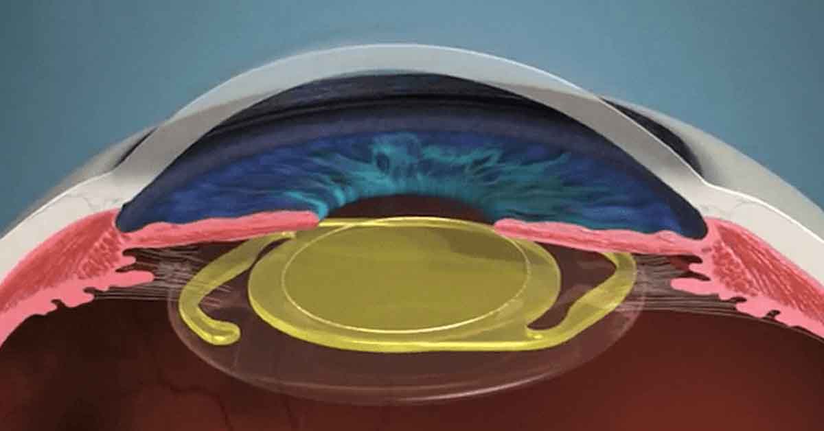 Lente intraocular: Como escolher o cirurgião de catarata