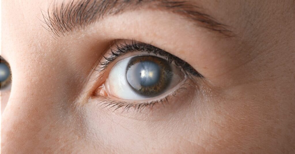 Melhor lente intraocular - como escolher e quais são as mais indicadas Cancelar