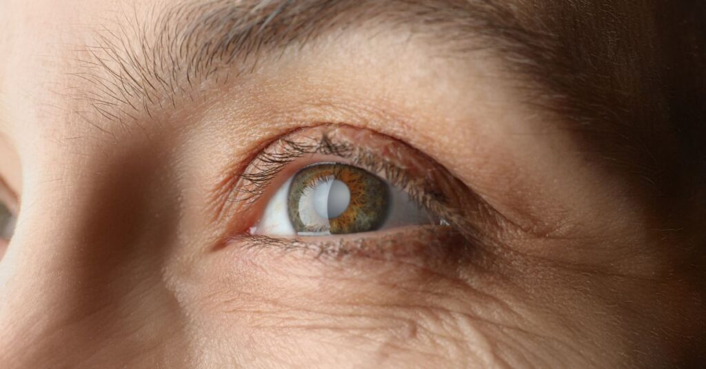 Quando fazer a cirurgia de catarata?