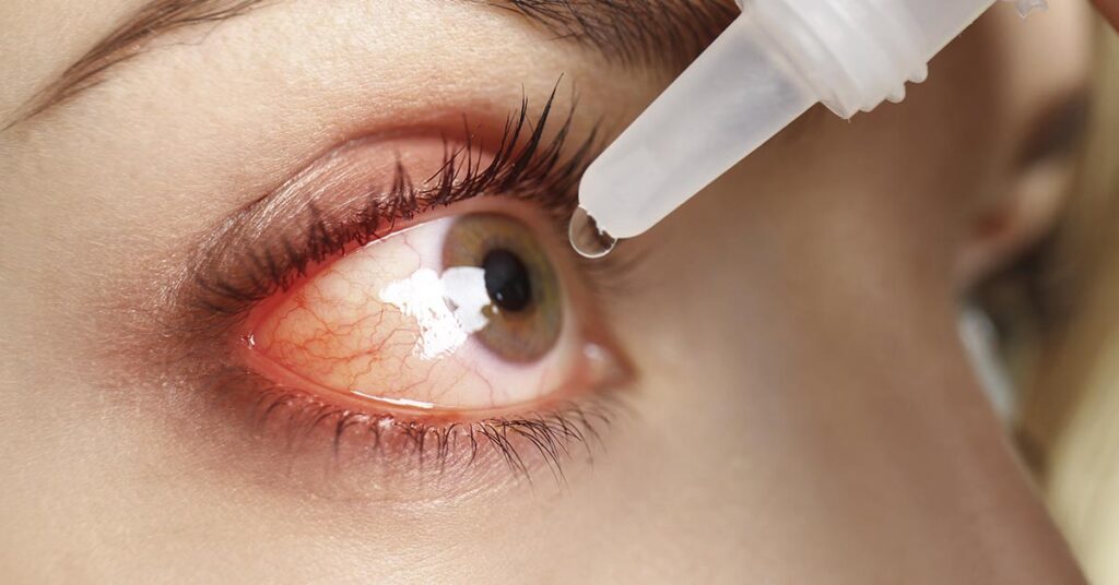 Glaucoma: é possível controlar a doença sem depender de colírios para sempre?