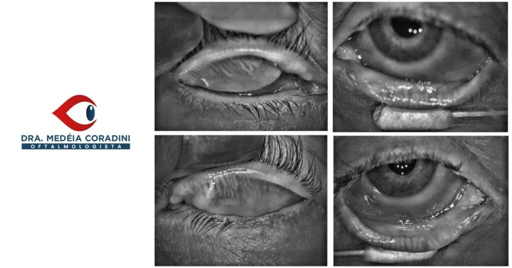 Meibografia: o exame que revela por que seus olhos ficam secos mesmo com produção normal de lágrimas
